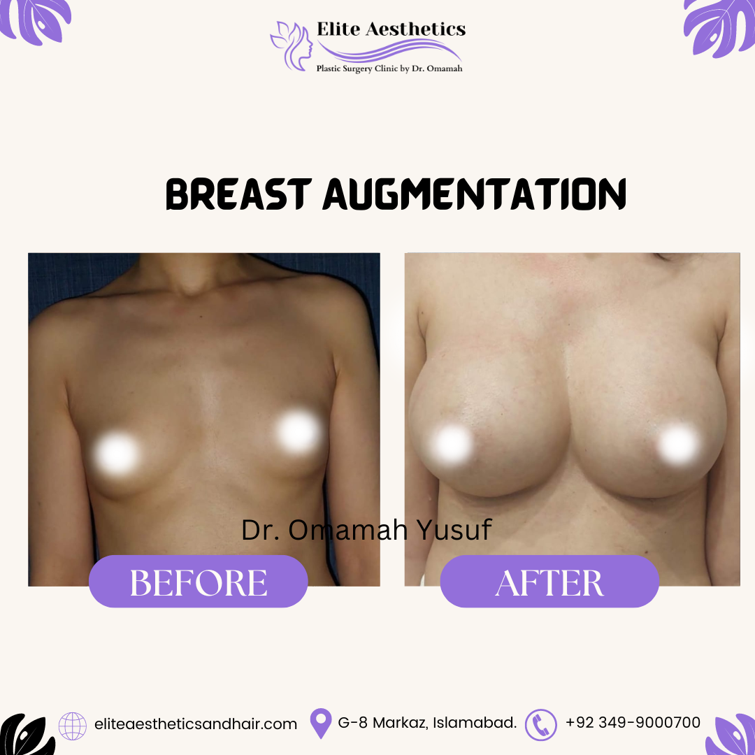 before-after-breast-augmentation