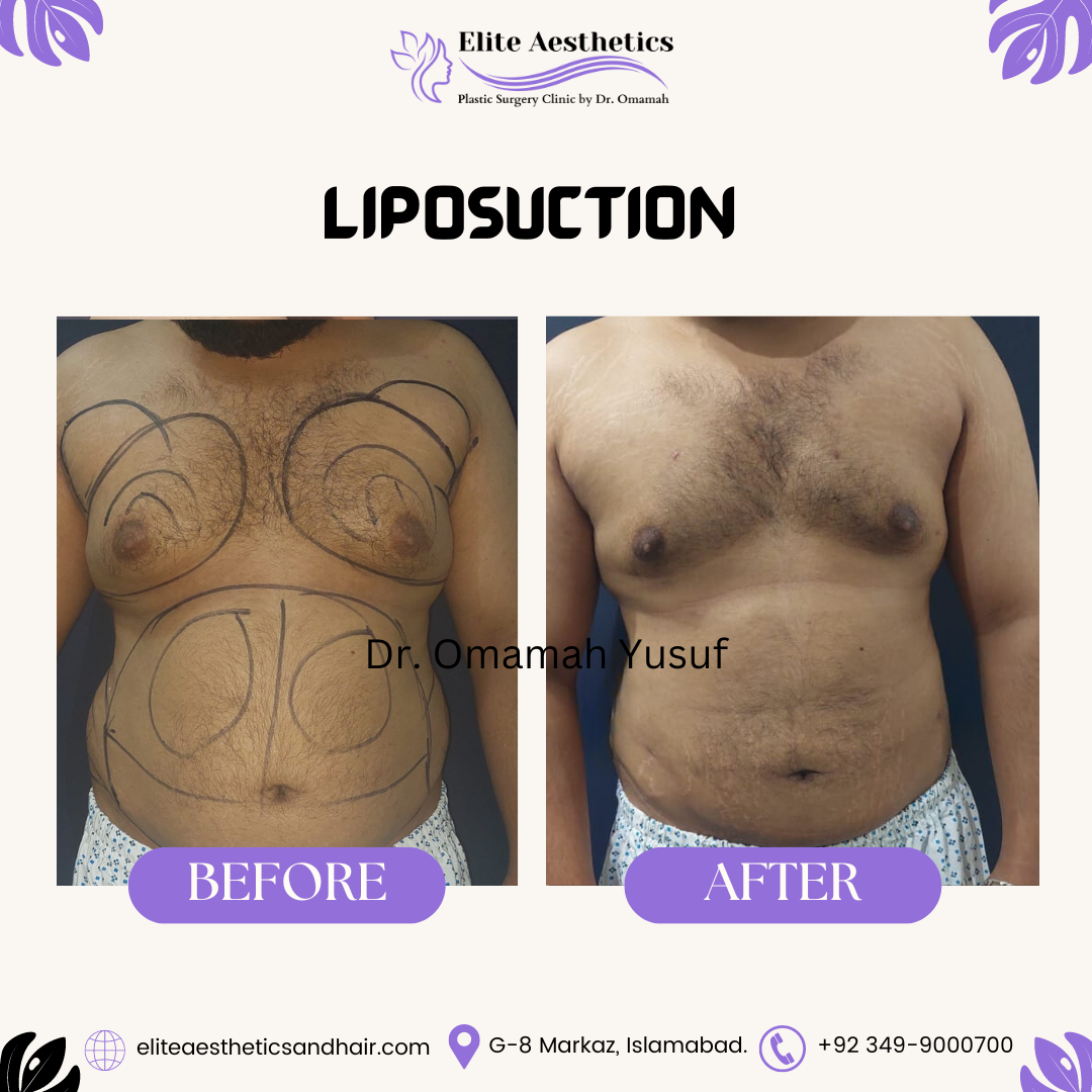 before-after-liposuction9