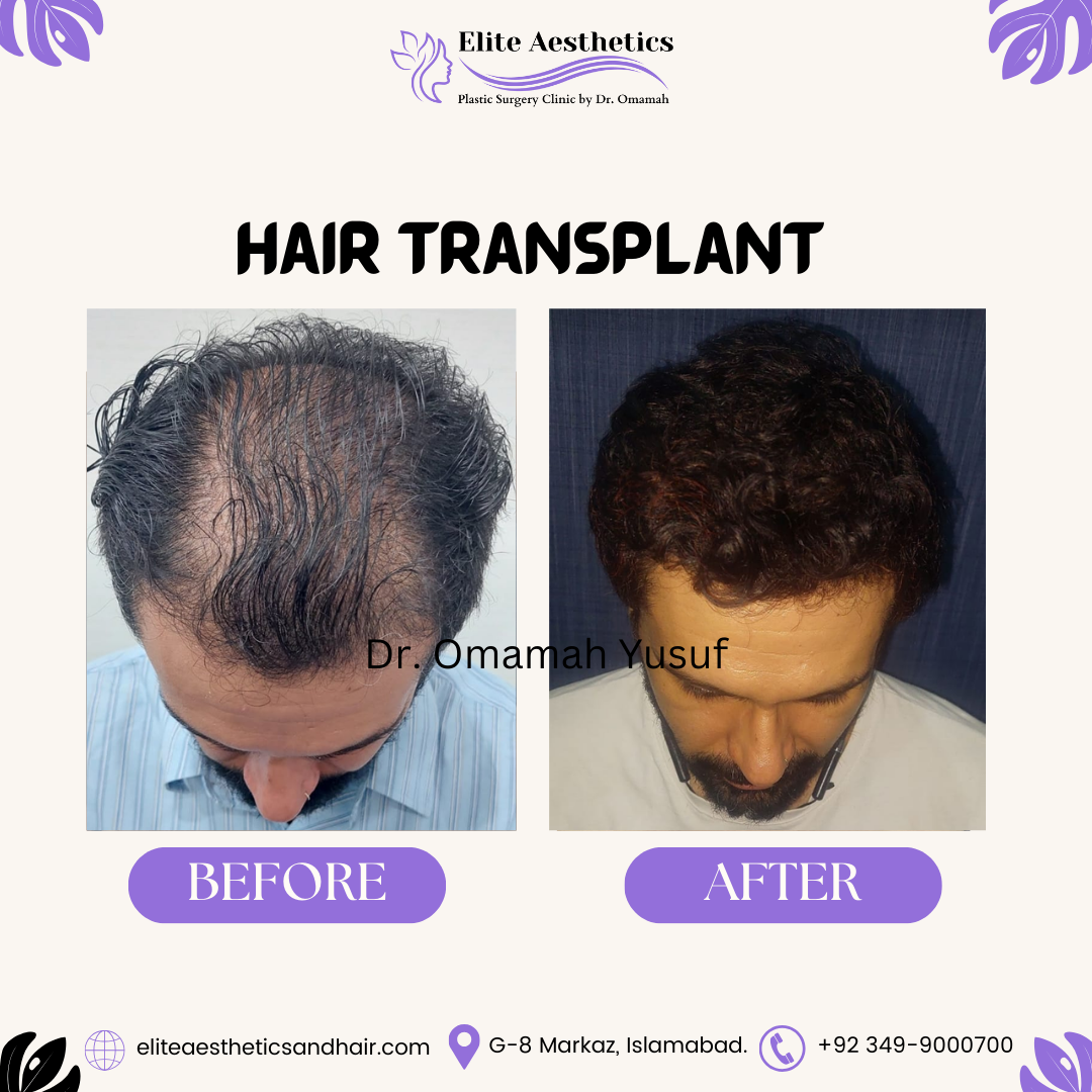 male-hair-transplant